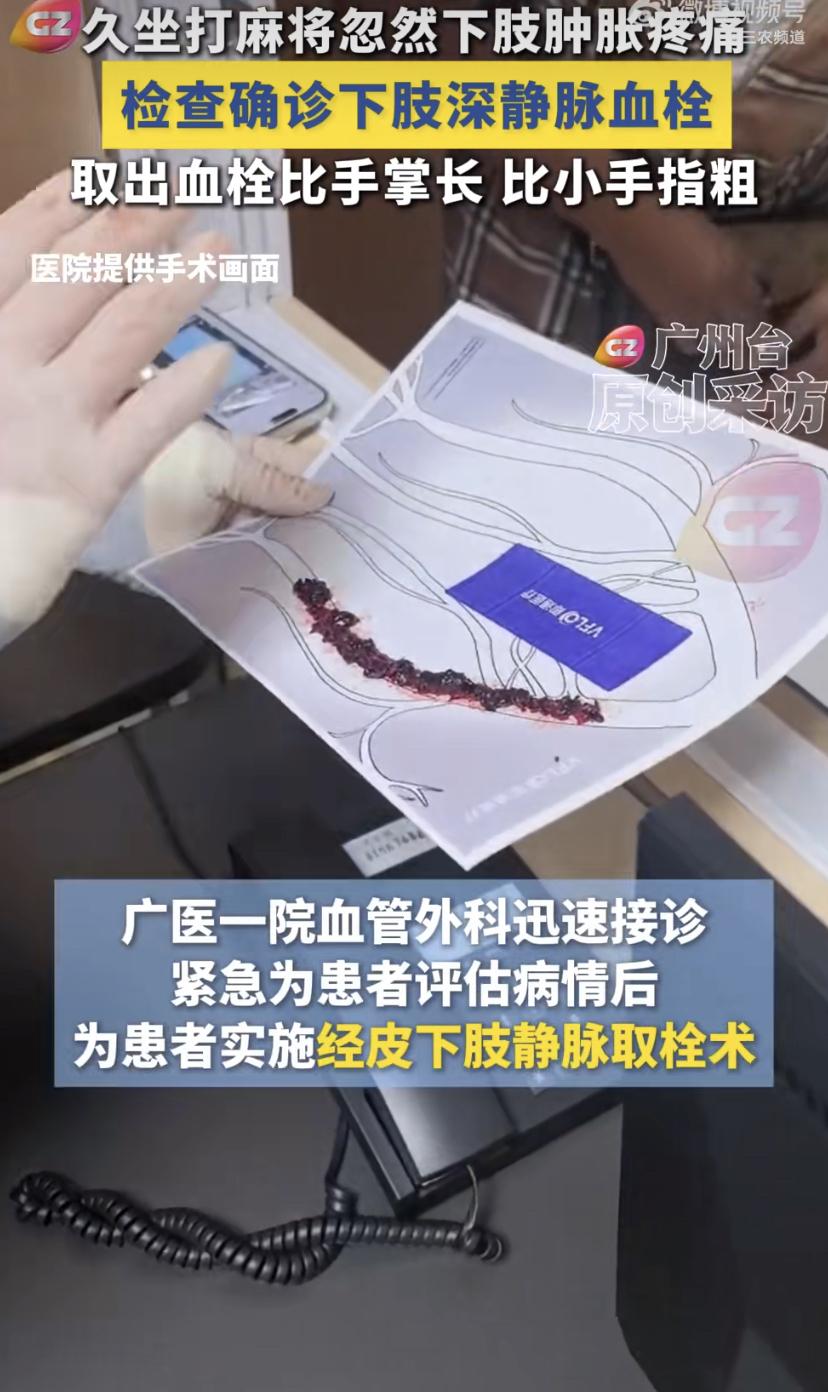 广州一位麻将爱好者差点出事!因为长期久坐，一条比小手指还粗，比手掌还长的血栓从腿
