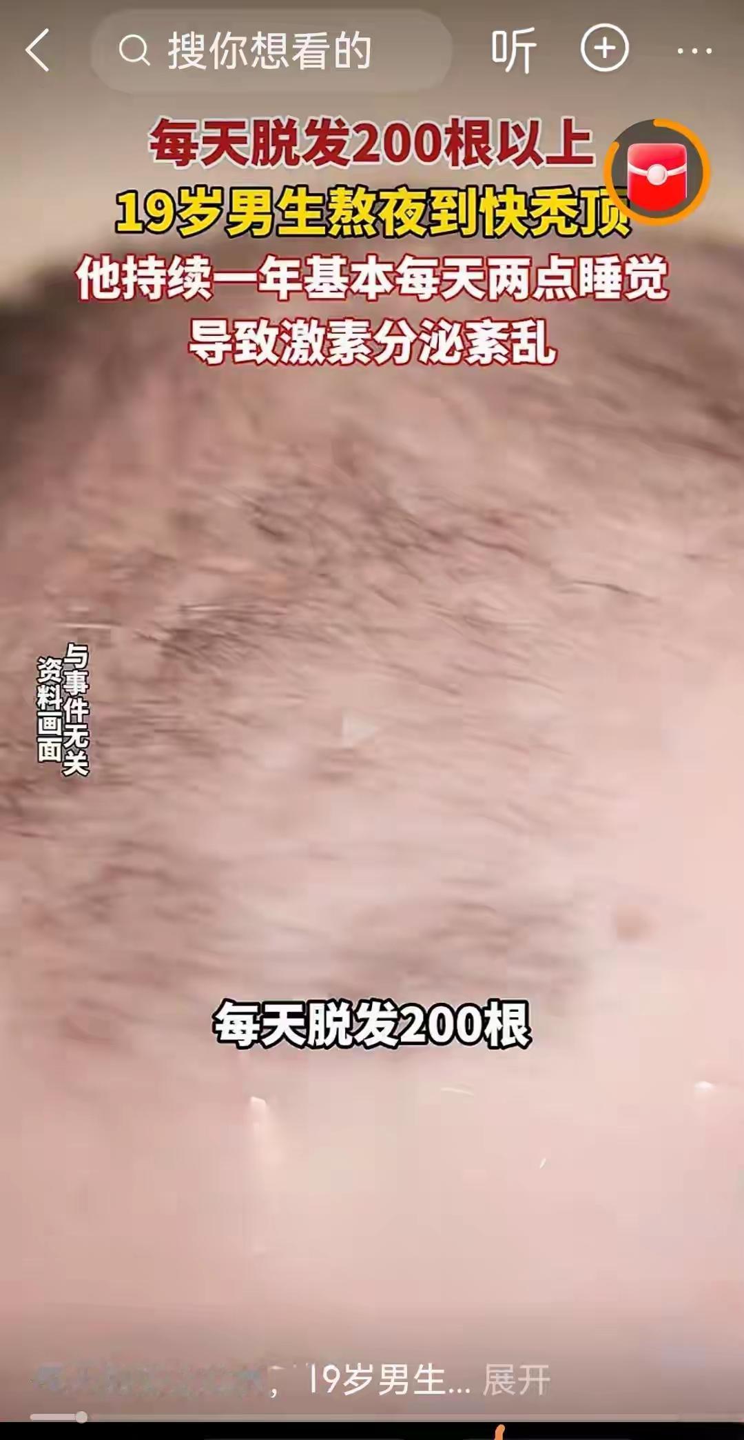 19岁郑州小伙熬夜365天头顶变“地中海”：凌晨两点的屏幕，正悄悄“杀死”你的青