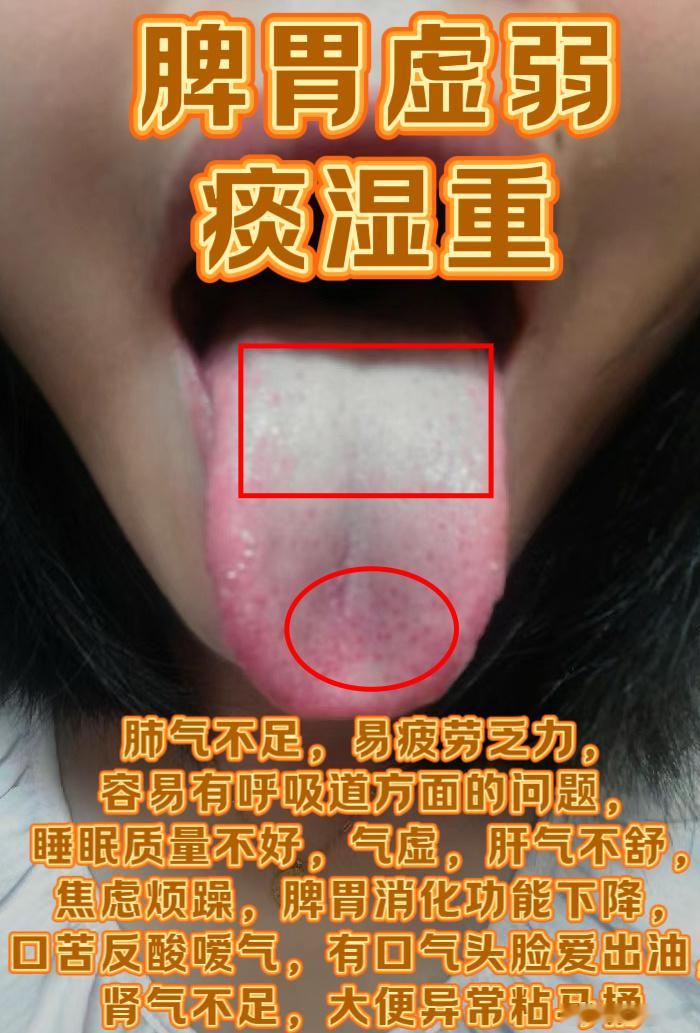 小儿湿郁化热致咳湿浊壅中久郁蒸无须定是肾阳轻过餐积滞生潮热壅遏肺气嗽难平薄食令脾