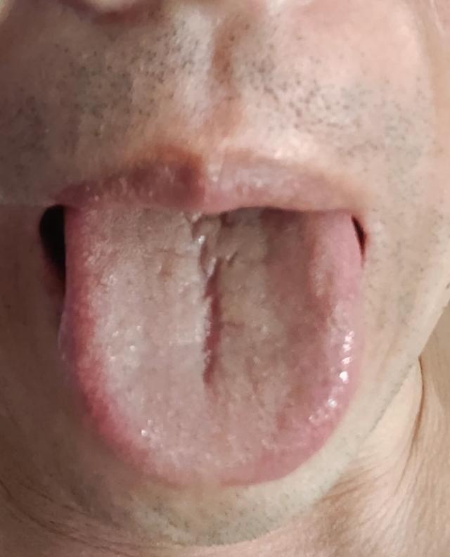 舌中裂纹这么深，你光以为是脾虚？太可悲了[泣不成声]
潘医只想说一句，“别再补脾