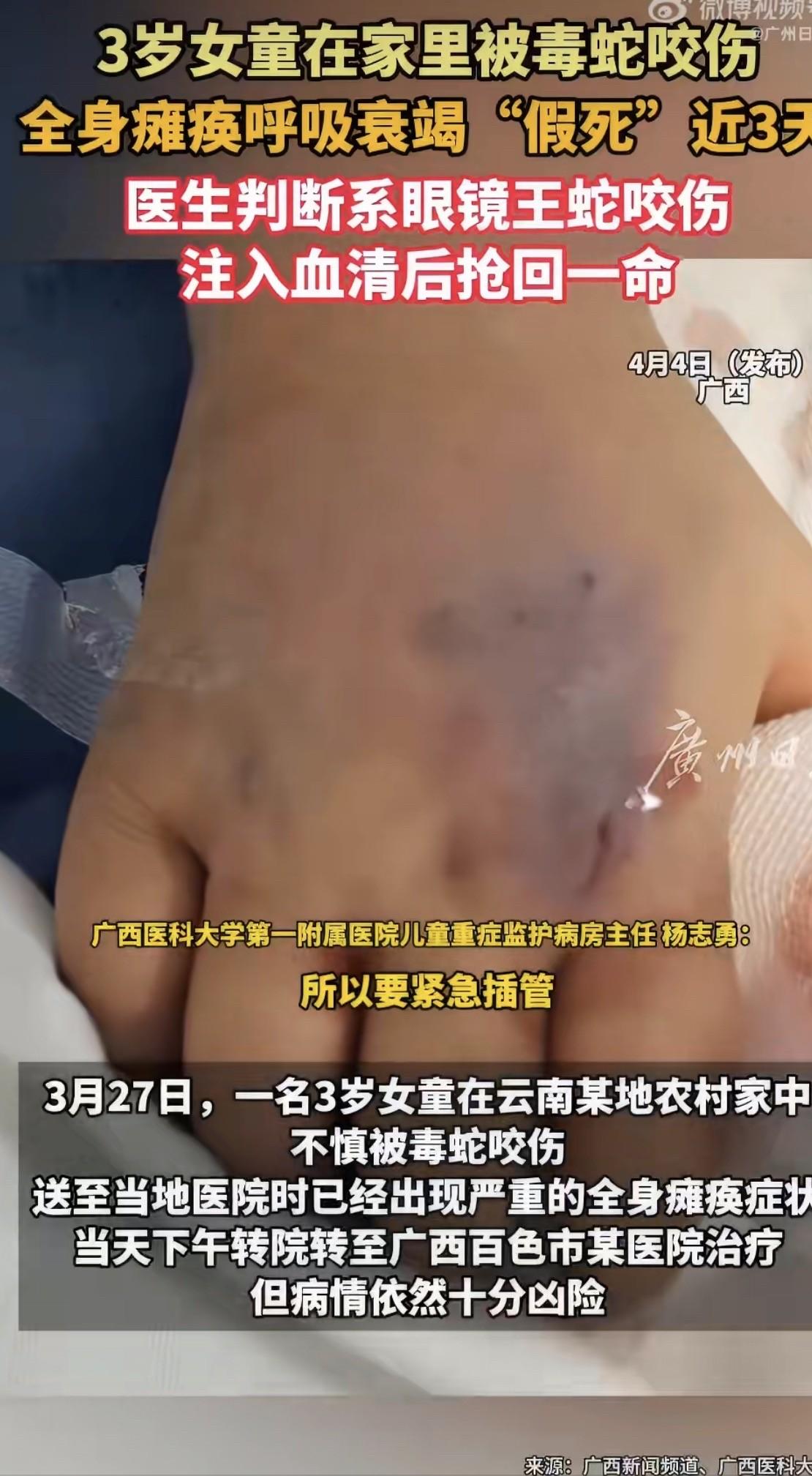 一个三岁小女孩，中午十二点在云南文山家里玩，被眼镜王蛇给咬了。半小时送到医院，人