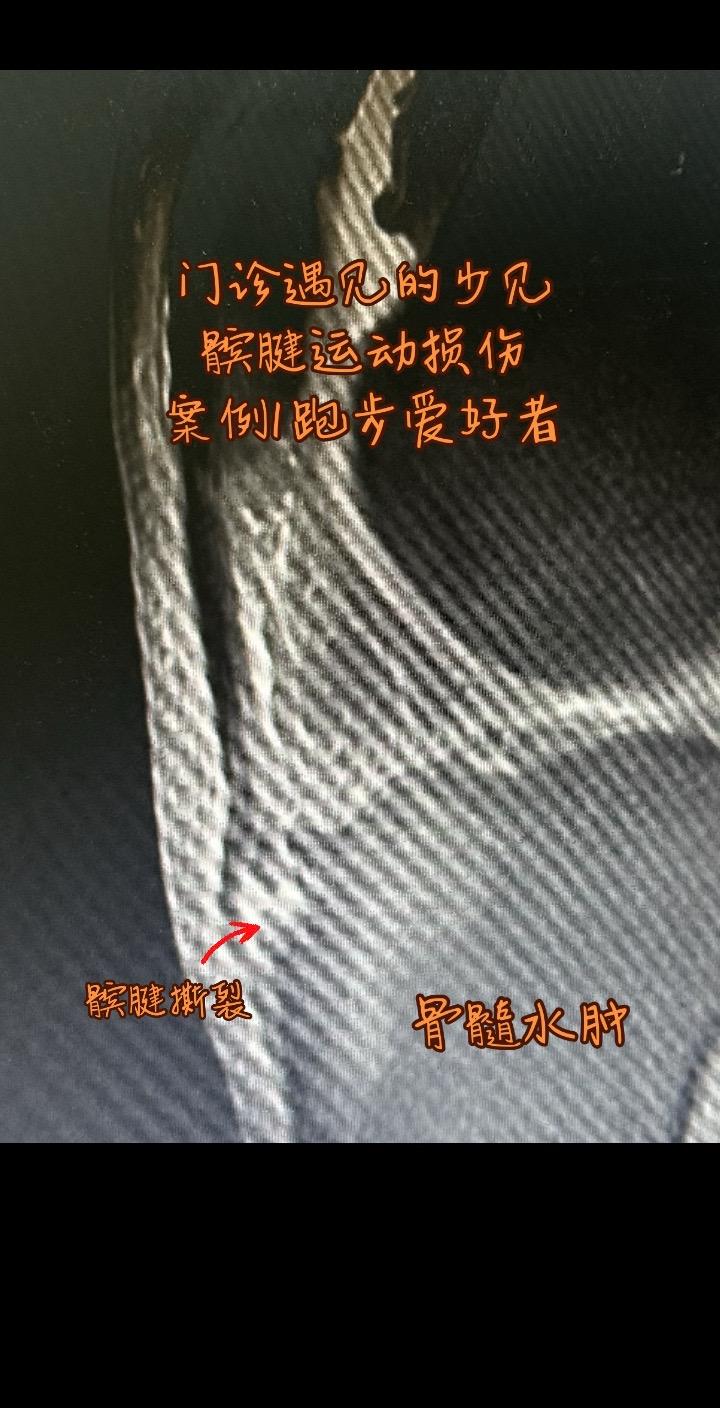这种所谓的髌腱炎为什么好不了。这些是髌腱撕裂 保守治疗很难痊愈