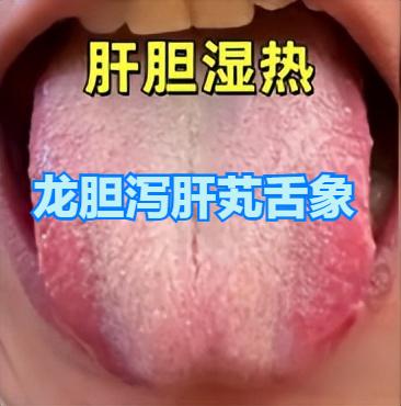 在中医理论中，湿热侵袭人体不同部位，会引发不同的病症表现，以下为常见的四种湿热证