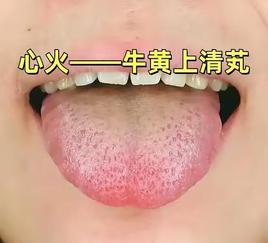 很多人一上火就乱吃凉药，越清越虚，其实关键是分清火在哪里。对照舌象和症状，4 种