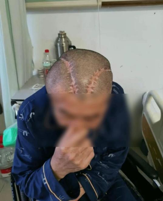 瞒出来的医患裂痕，比手术失误更致命
 
谁能想到，右脑出血却被开了左脑，术后医院