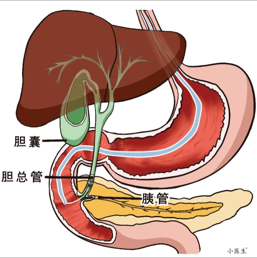 胆管癌梗阻性黄疸ERCP术中N多次想放弃。想想患者还是坚持了，成功那一...