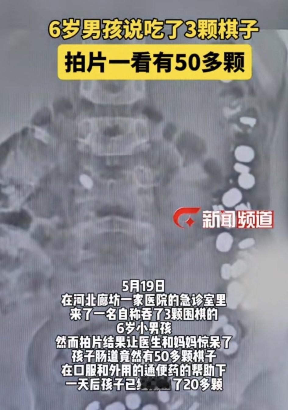 万万没有想到，河北廊坊，一名6岁男孩玩着玩着，突然告诉妈妈自己吞了3颗棋子下肚，