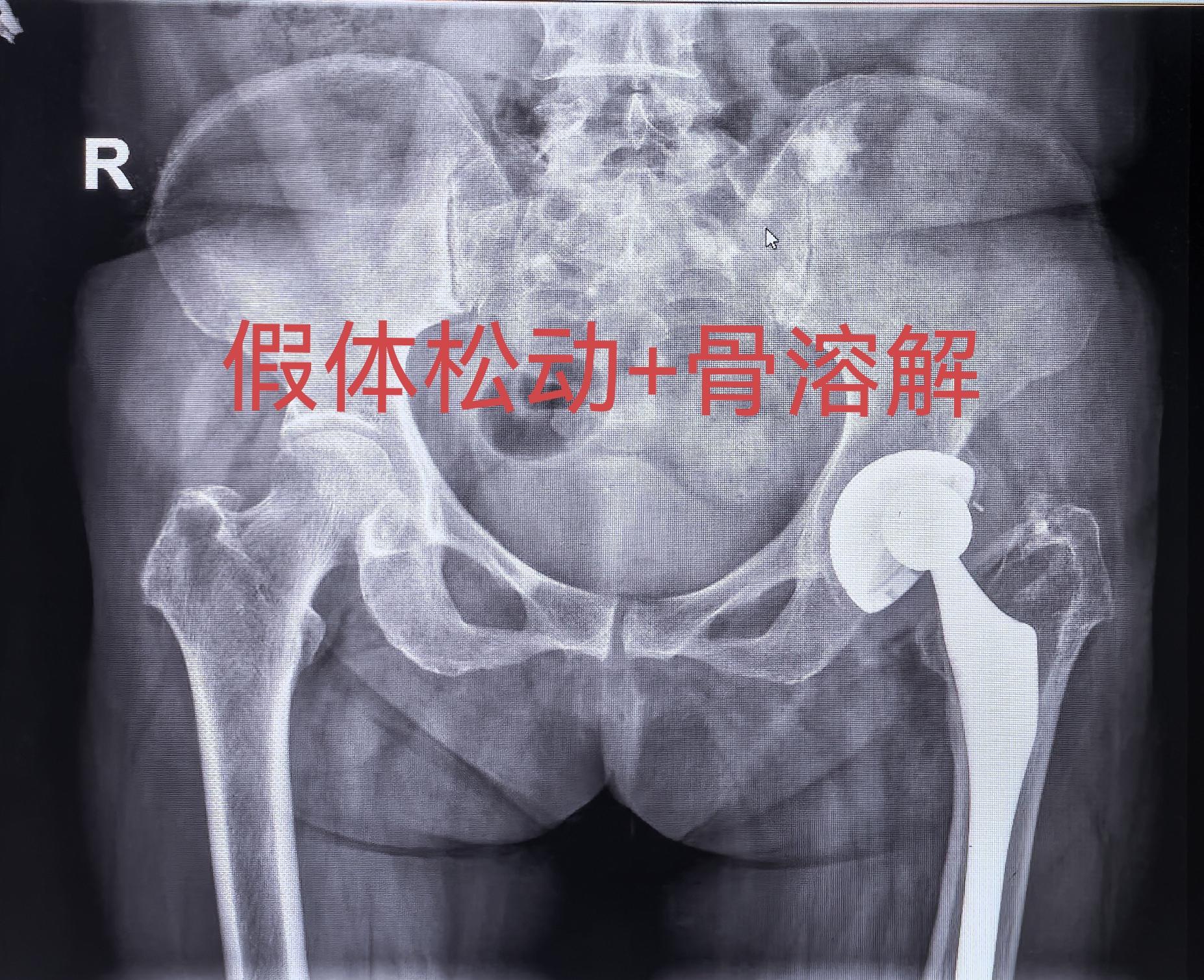 髋关节翻修，髋关节置换。股骨头坏死髋关节置换术后22年假体松动，83岁...