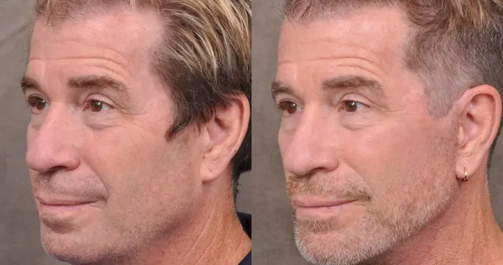 硅谷祛眼袋，海淀求嫩膚：中外科技老哥都在偷偷卷顏值