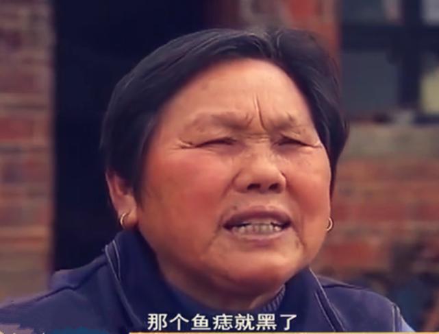 “救救我吧医生！”1992年湖南一小伙的手上一夜之间长出“树枝”，而且还剧痛难耐