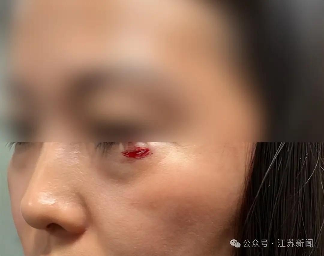 黑龙江，一女子躺火车下铺睡觉，谁料，上铺的人手机没放好，滑落后正好砸中女子的眼周