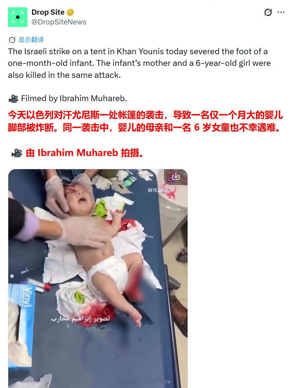以色列今天在加沙的暴行记录。这个才一月大的婴儿不但失去了母亲，也失去了一条腿。我