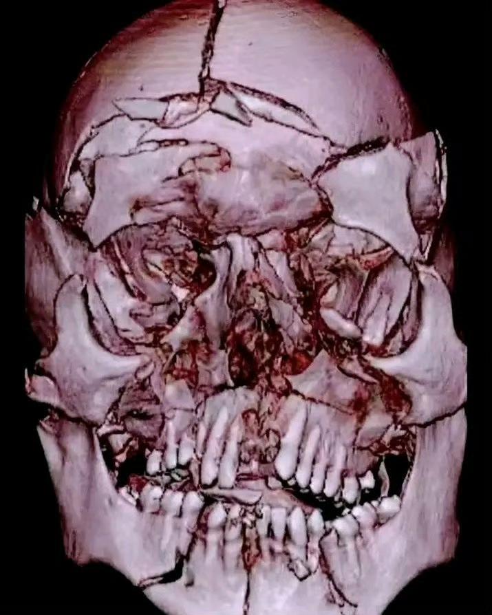 惨！患者坐在汽车的前排，没有系安全带，汽车发生事故时被甩出车外，迎面扑倒在地上。