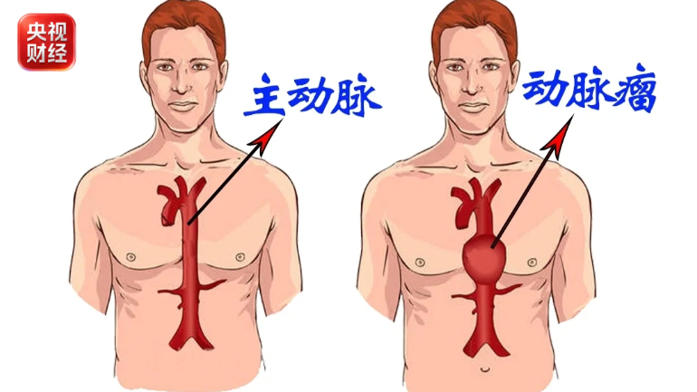 #冰啤酒喝出主动脉夹层破裂#【男子喝冰啤酒后休克！血管疾病的“头号杀手”】 #致