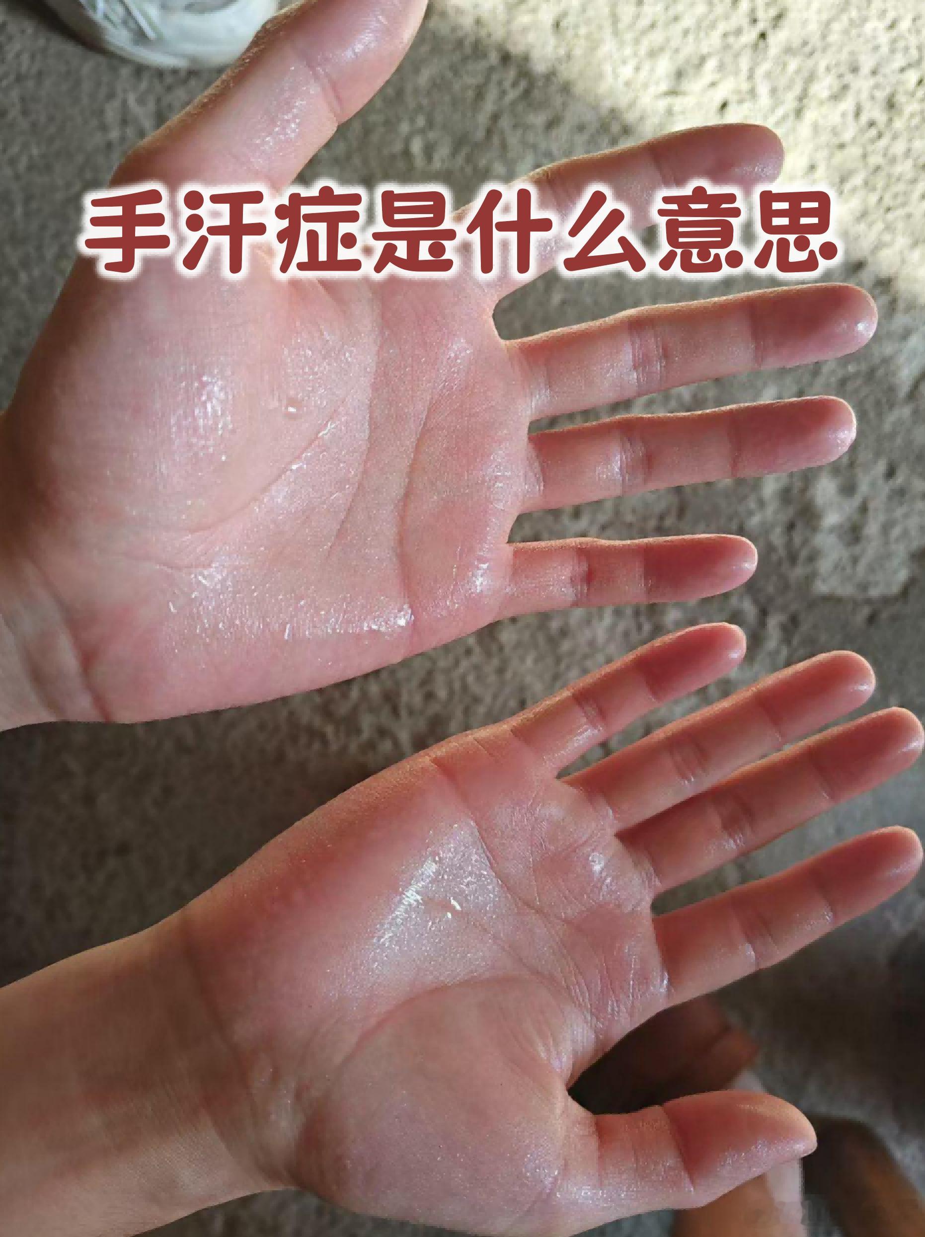 三类手汗分型论治三方（气虚/阴虚/湿热）总述手汗症不可一方通治，临床核心分为三大
