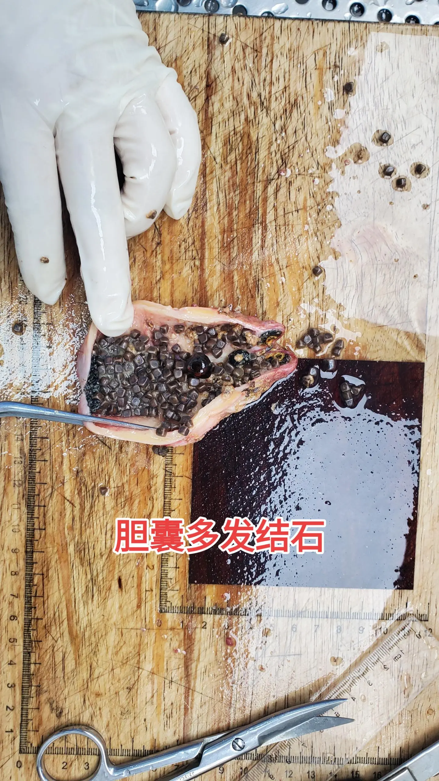 胆囊结石胆囊炎