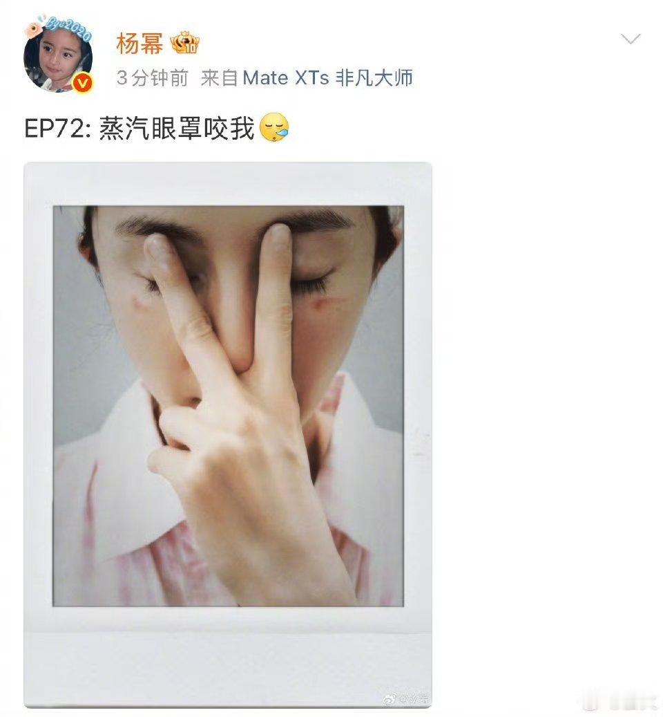 杨幂说蒸汽眼罩咬我我也被这玩意烫伤过，用的时候要注意蒸汽眼罩坏了！好明显的烫伤红