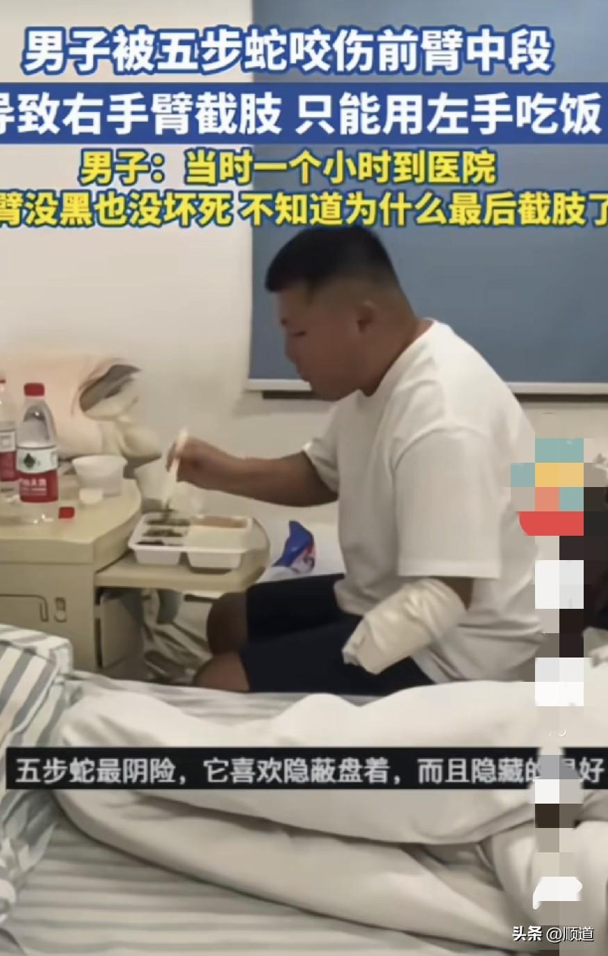 男子右前臂被五步蛇意外咬伤，一个小时之内就到了医院，当时手臂没肿也没黑，最后却截