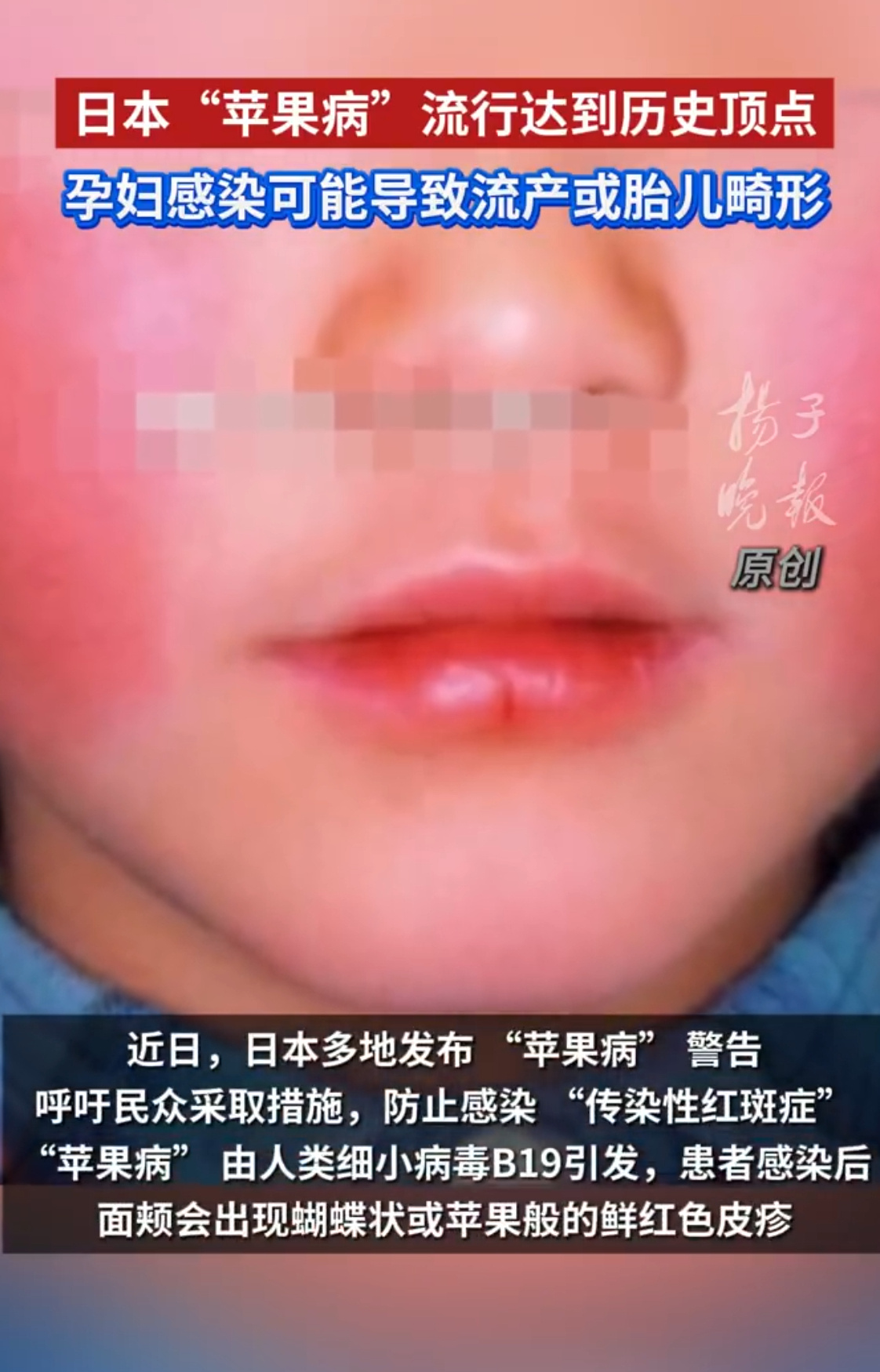 日本 苹果病 看标题还还以为是......原来是传染性红斑，俗称苹果病，冒昧了[