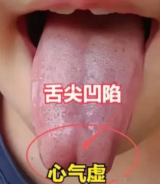 舌尖凹陷多是心气虚“报警”！一剂养心汤，益气安神稳心神
 
大家好，我是陈大夫！