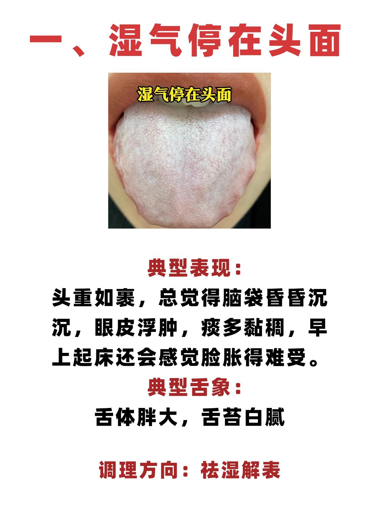 湿气停在哪？5个部位+舌象对照，对症祛湿才有效！