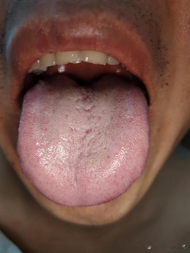 遇上这样的舌头，那可真让人头疼[皱眉][皱眉][皱眉]
主诉就是：没劲乏力，胃里