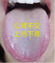 看看这个舌头，红成什么样了，火气还这么大，也难怪“见花谢”
 
患者情况：男科差