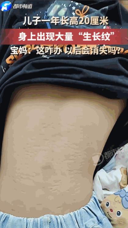 安徽男孩一年暴长20厘米，满身紫红色纹路引家长担忧，真相竟是这样。

8月9日有