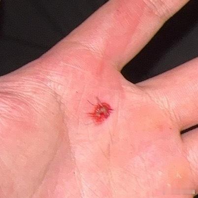 早上的🦟是真的饿啊😧 ​​​