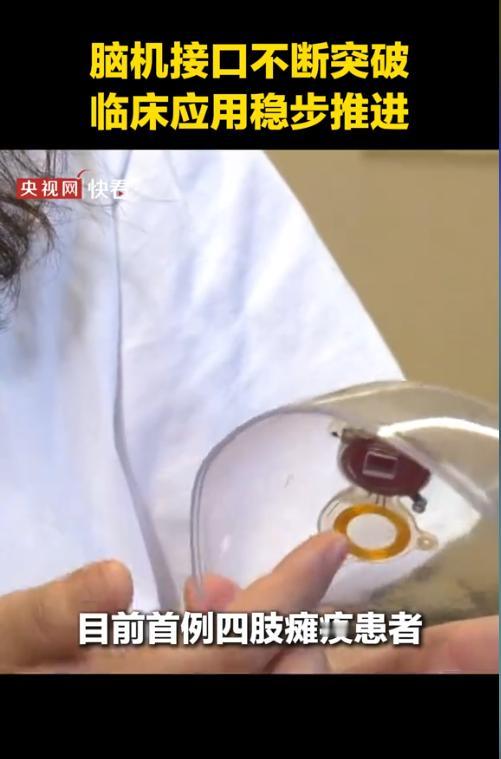脑机接口再破壁垒，瘫痪患者重获“动手权”，抑郁症患者也有新希望
最近，脑机接口又