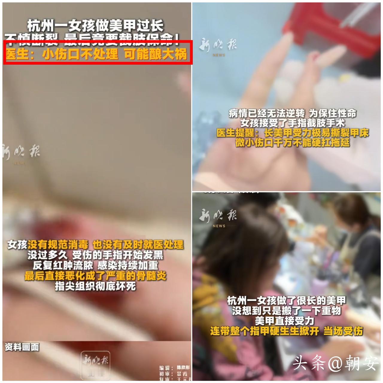 太扎心了！

杭州年轻女孩为了追求超长美甲，最后竟无奈指尖截肢，看完真的浑身后怕