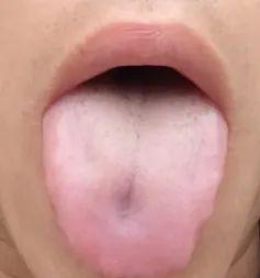 “舌象坑洼之谜：脾虚还是肝郁？”
对于这位年轻的患者，舌象呈现出坑坑洼洼、裂纹纵