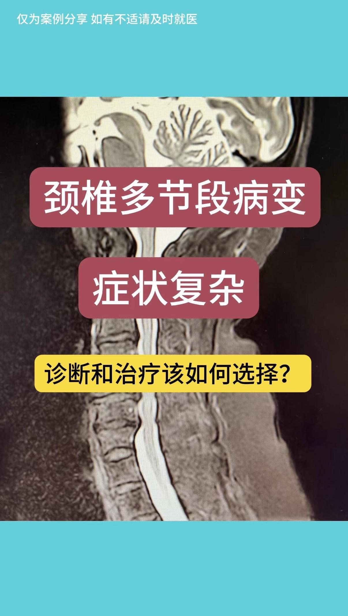 60岁女性，右上肢疼痛麻木，右手肌肉萎缩半年。查体右手大小鱼际肌及骨间...