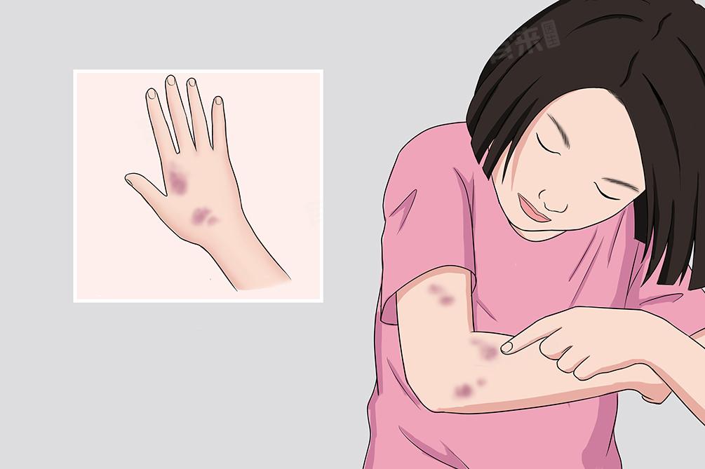 血小板减少症的护理措施

血小板减少症是指血小板数量低于正常值，容易引起出血的一