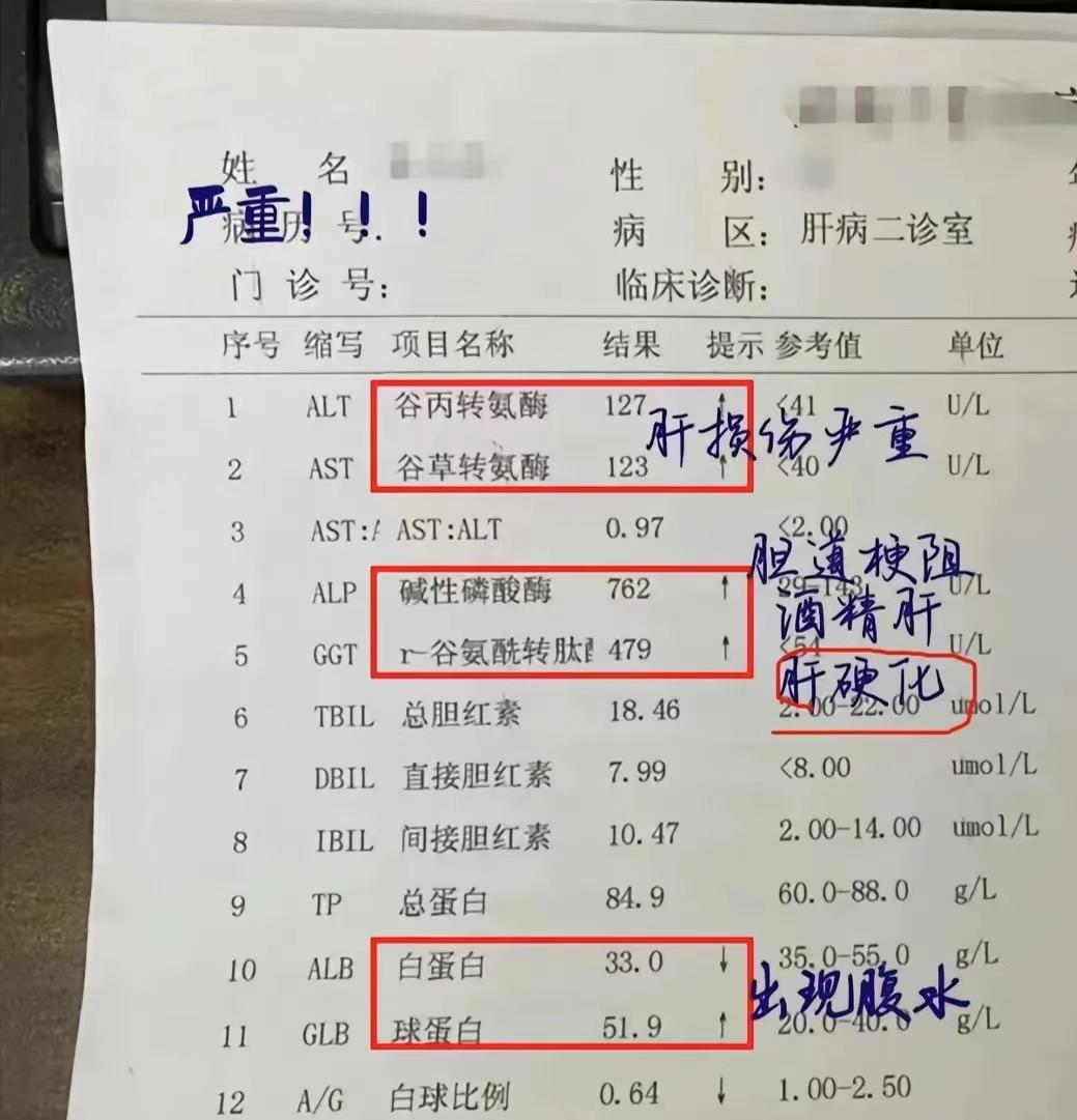 山东聊城的这位肝硬化患者病情已经很危急了！
大家注意一下肝功能，这三个指标的异常，每一项的升高都要警惕是不是肝硬化在加重！