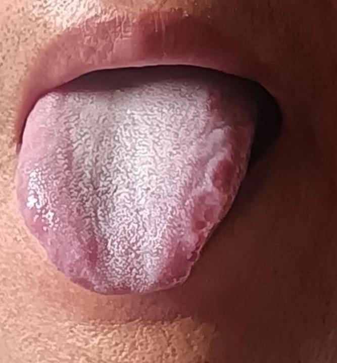 这样的舌象，乱吃六味地黄丸，恐怕越吃越严重，怎么就是不听劝呢！

患者主诉：吃不