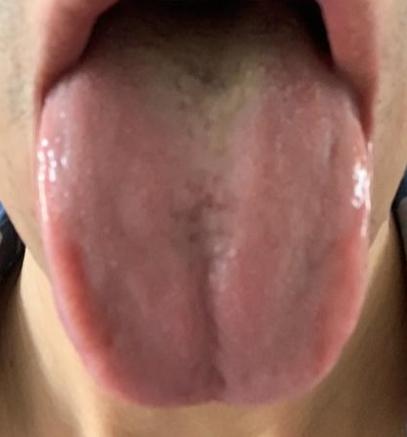 这种鼓胀的舌头，一定要记得看底下青筋，不然容易越补越糟。
 
主诉：胸闷，上火，