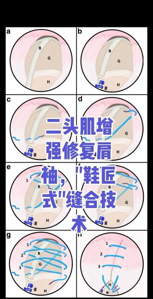 "鞋匠式"缝合技术。关节镜下肩袖修复中肱二头肌增强无结缝合技术