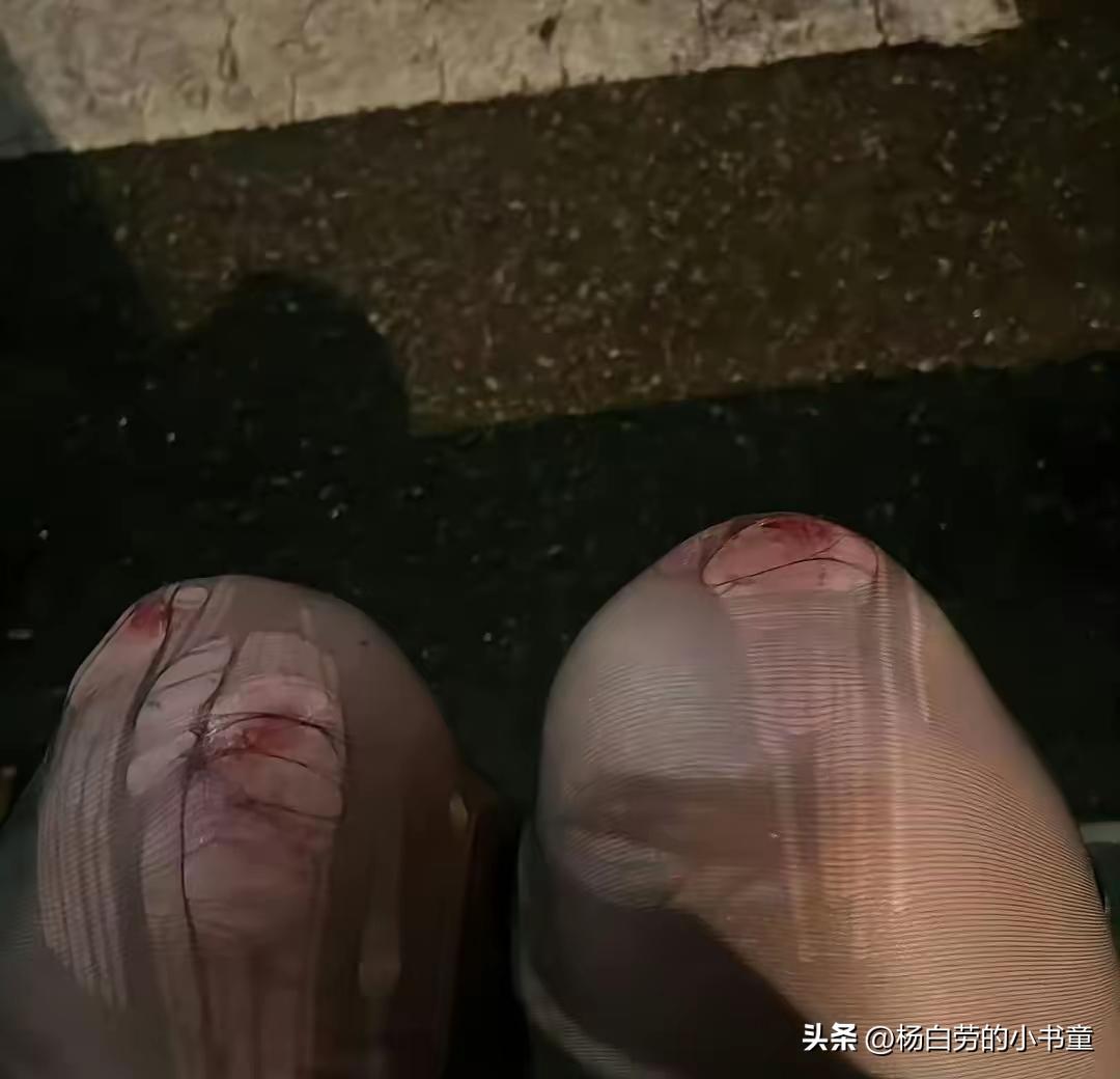 昨天喝多啦 摔成这样啦
看起来就心疼
下次一定长记性
喝酒前穿裤子就不会摔成这种