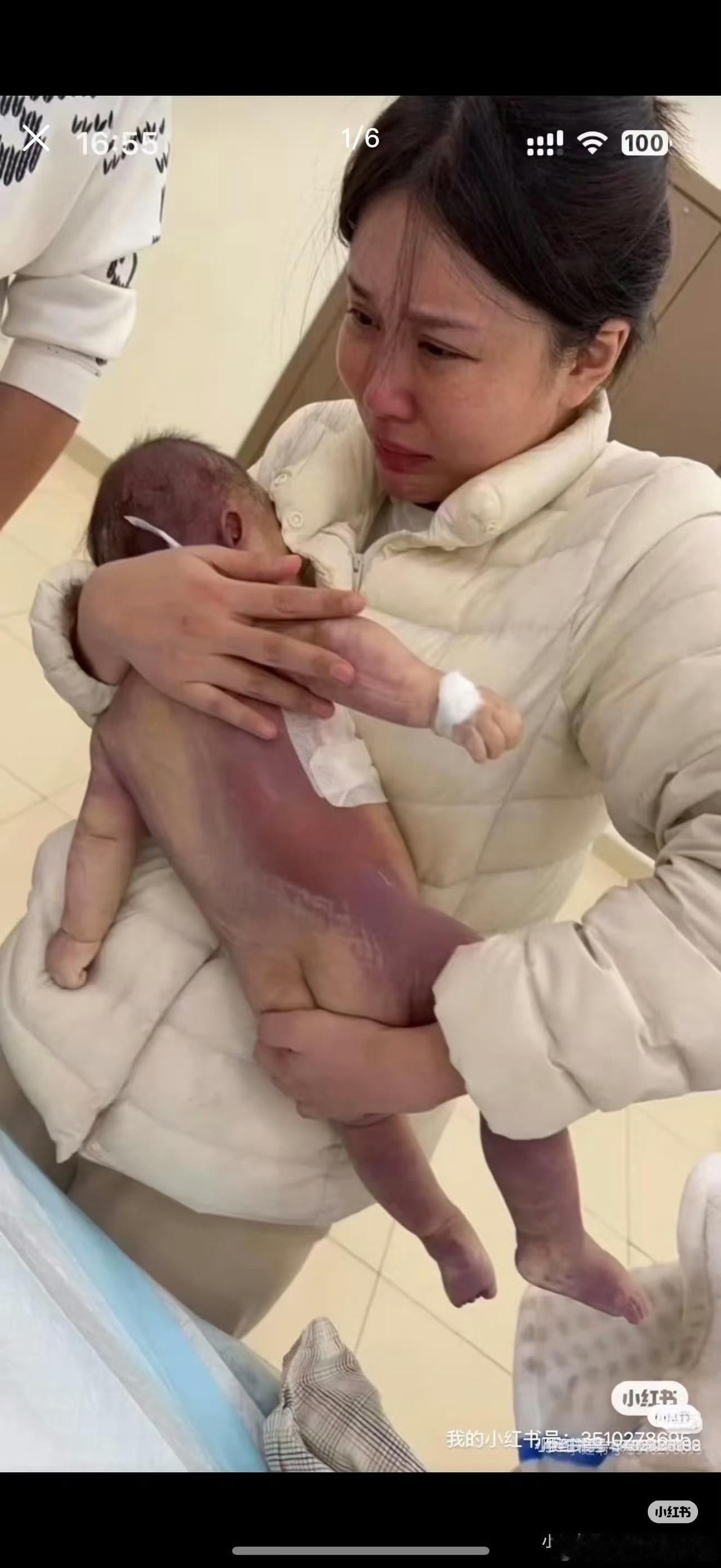 可怜的宝宝！支持妈妈讨回公道！
5个月大的女婴因为是早产，发现其心脏间隔缺损2个