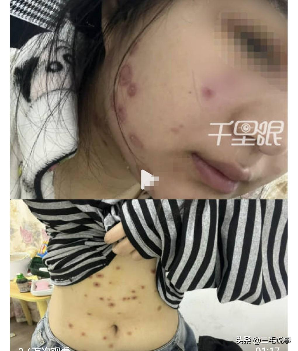 想不到养猫还有这样的风险，真是让人瑟瑟发抖。

近日，女生800元买猫被传染全身