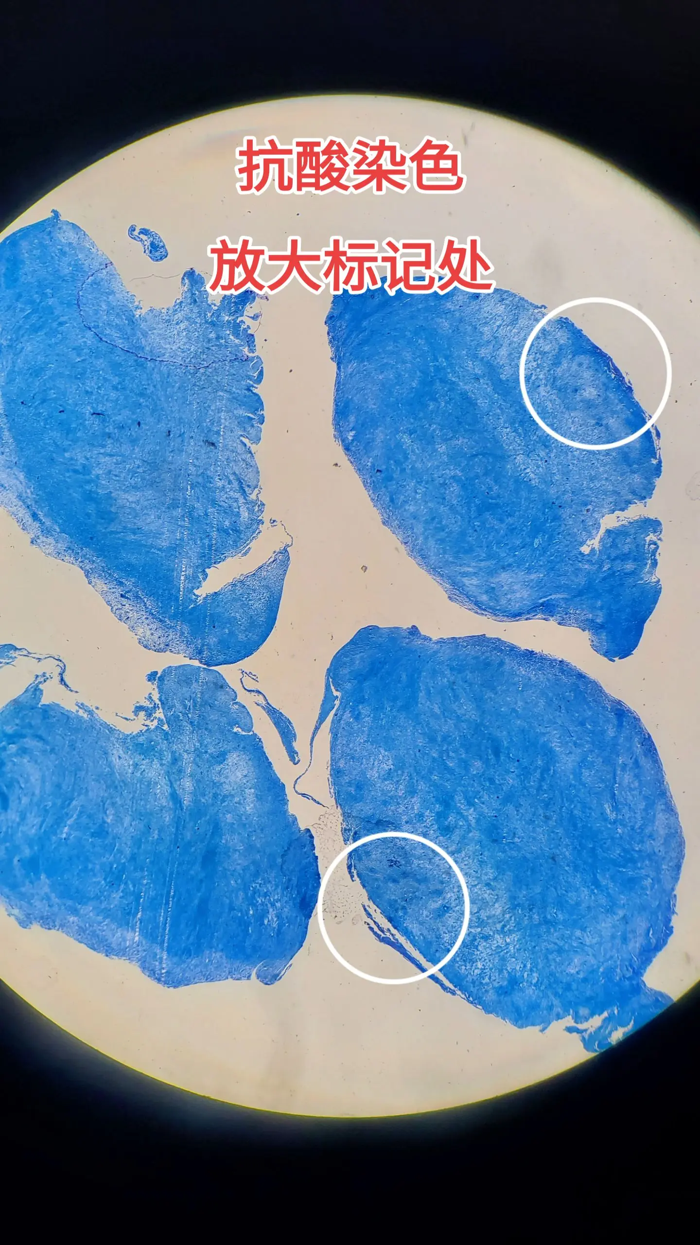 抗酸染色 结核