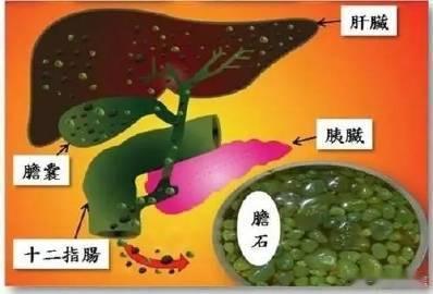 如何预防，肝胆结石？1，调节饮食起居；主要是注意食物的质与量，避免摄入高蛋白质、