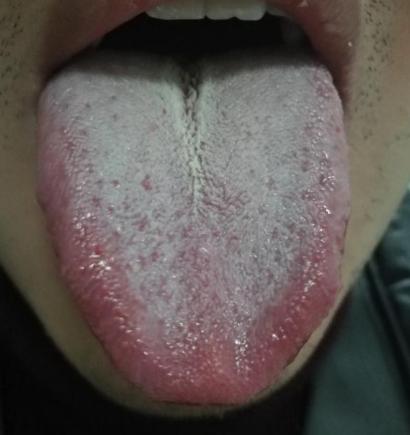 碰见这样的舌头，可千万别着急去补肾，不然只会雪上加霜！
 
患者：那方面不行，平