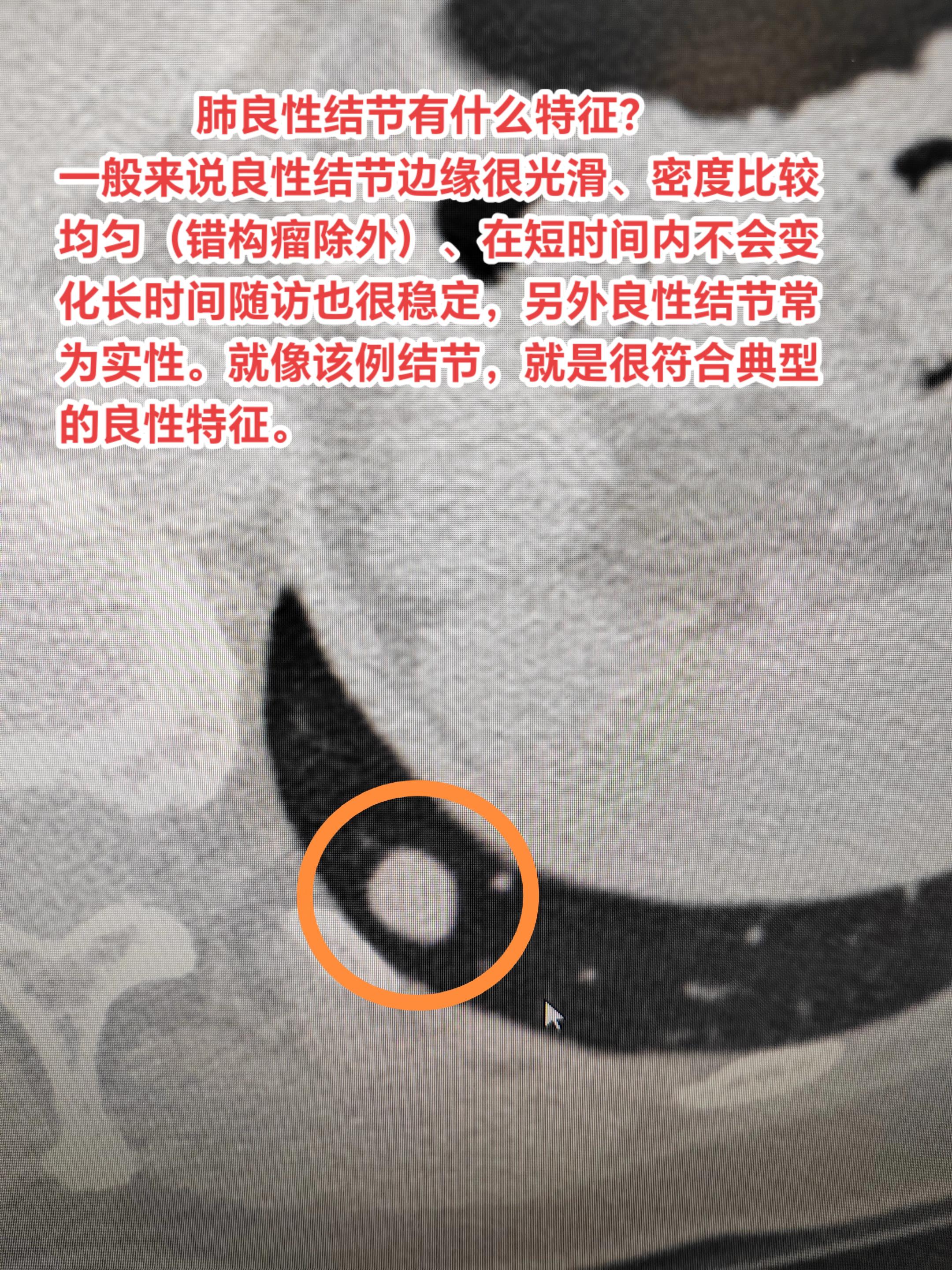 肺良性结节有什么特征？一般来说良性结节边缘很光滑、密度比较均匀（错构瘤...