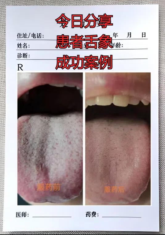 【舌诊分享】想要快速消白苔，还得看附子理中丸，白苔消退，舌面平整！

我们来看患