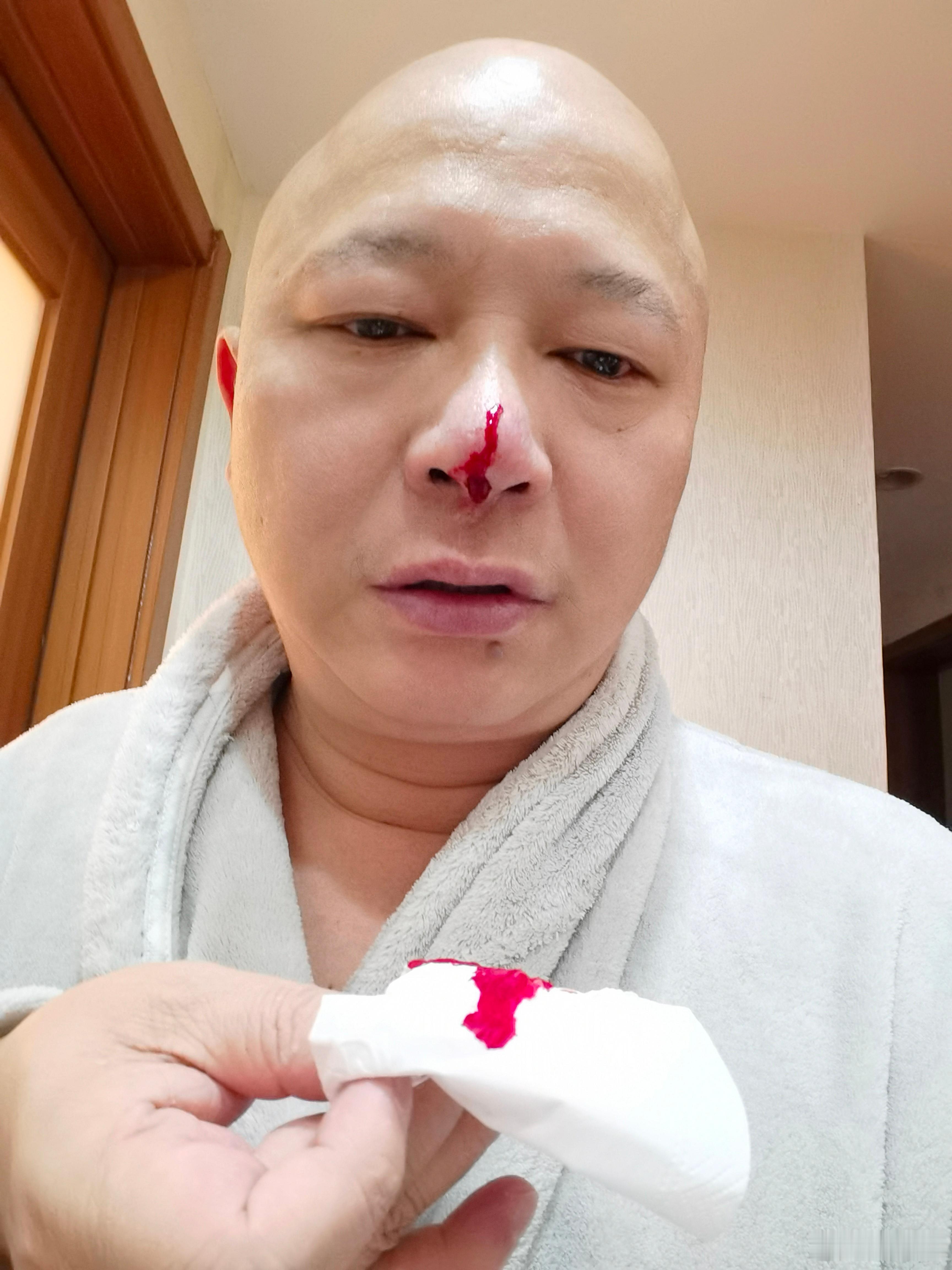 感觉最近要赚大钱，出红多在北京时候感觉鼻梁血丝多，回来就用放血针放血，这是老中医