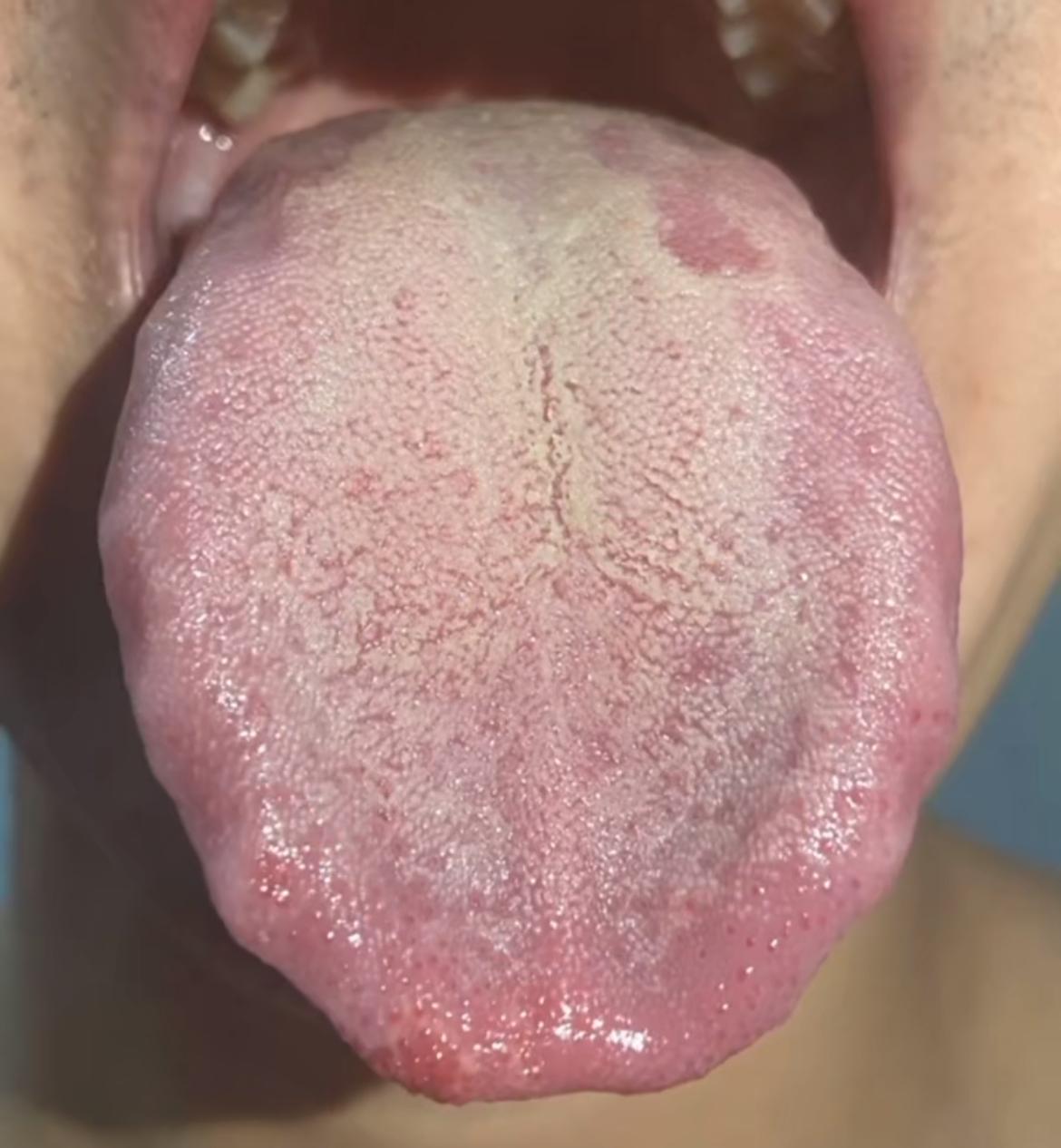 伸出舌头这一刻，我头就开始疼了[捂脸]
平时表现，大腿根潮湿，尿还多，急躁易怒
