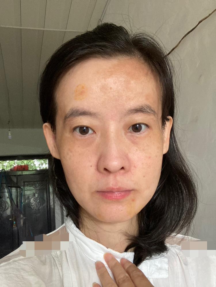 前几天拍的照片。额头斑片太明显了，我好着急去看病。我从来没有自卑过，但是这个额头