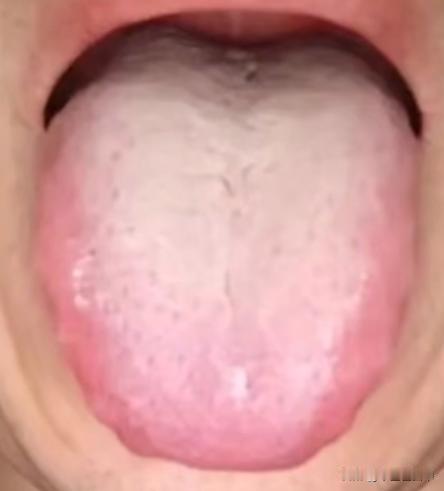 舌苔又厚又腻，二陈丸为啥没效果？都是因为你忽略了这一点

病人主诉：痰多，脾气比
